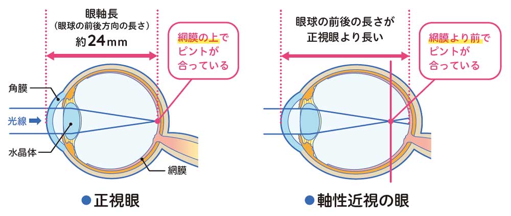 近視の進行を抑制することが大切な理由