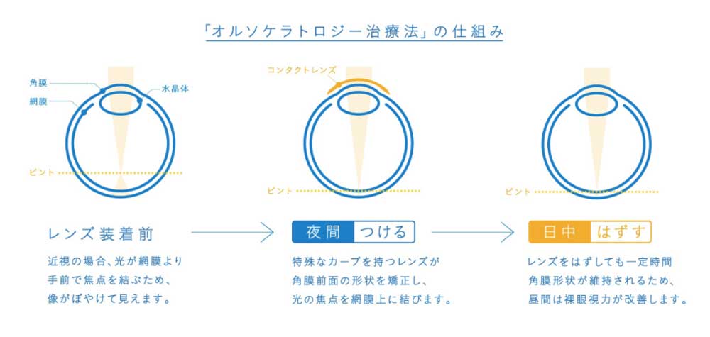 「オルソケラトロジー治療法」の仕組み