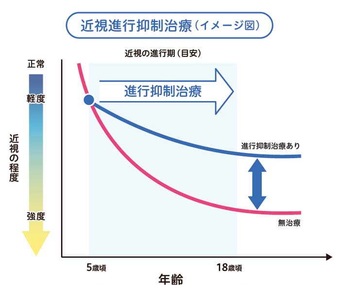 近視進行抑制治療（イメージ図）