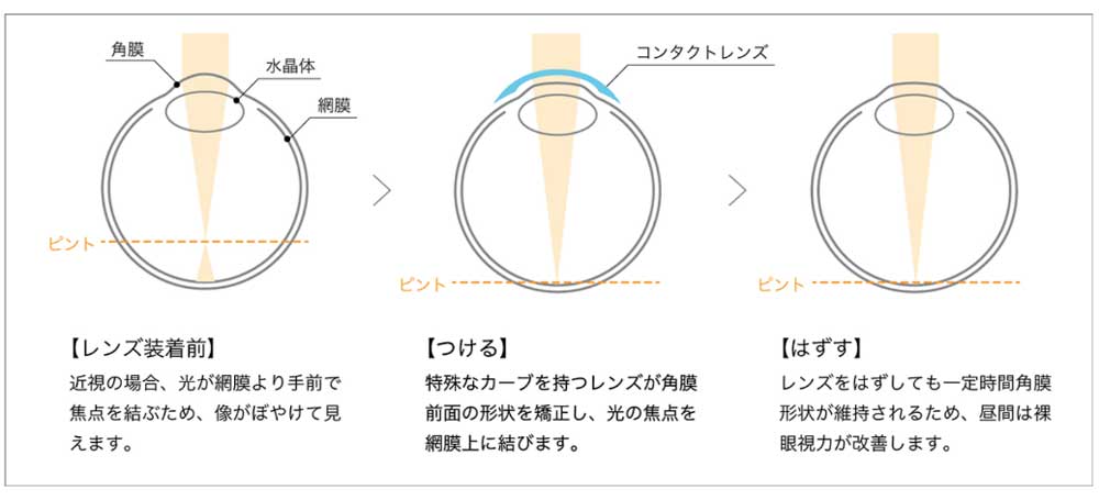 オルソケラトロジー治療法のしくみ